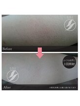 ラディアアンドココサロン(Radia&Coco_salon)/ふくらはぎ脱毛ビフォーアフター