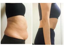 ストルツ(STOLZ)/体脂肪率がなんと-12%！