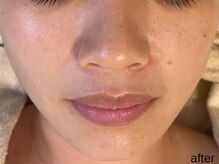 サロン ド エメ(salon de aimer)/【After】くすみ抜け♪美白肌