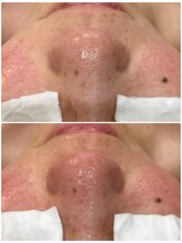 叶(Kanau)/【毛穴エクストラクション】