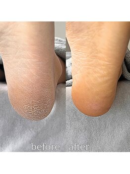 フットミー(foot mii)/むくみも見た目も◎