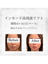 メディカルエステ 東銀座店/業界初インモード高周波リフト 