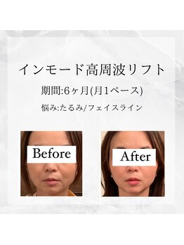 メディカルエステ 東銀座店/業界初インモード高周波リフト 