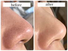 シェミー(CHEZ MEE)/【即効性】毛穴洗浄・イオン導入