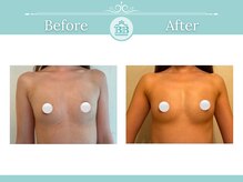 美人バスト 渋谷店/【バストアップ☆育乳】◇症例◇