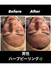 フーレスト アンド フリーリー(Fullest&Freely)/ハーブピーリング