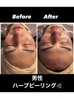 フーレスト アンド フリーリー(Fullest&Freely)/ハーブピーリング