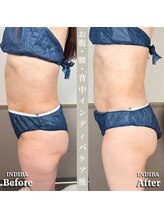 術後の女神 大阪心斎橋店/術後ケアインディバ・インディバ