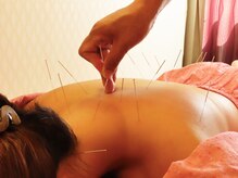 プロぺ鍼灸整骨院/背中鍼・マンツーマン施術[鍼灸]