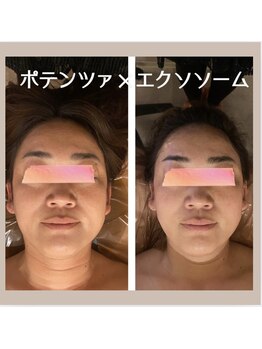 ナナイロ(nanairo)/ポテンツァ×エクソソーム