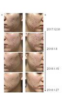 グラン治療院 東京/美容鍼でのニキビの経過 1