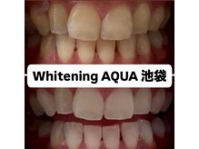 アクア 池袋店(AQUA)/ホワイトニング/池袋/東京/美白