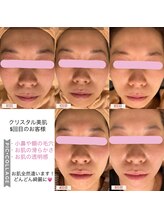 パルティノ 高崎店/【症例】クリスタル美肌エステ☆