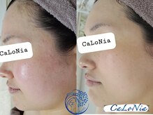 カロニア(CaLoNia)/肌質改善