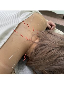 ヒューマン鍼灸接骨院/少ない本数で効果◎の筋肉鍼♪