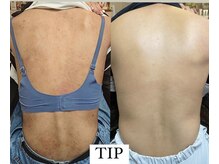 イベリス(Iberis)/ハーブピーリング/背中