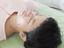 明大前はり灸院/人気の美容鍼+全身鍼灸施術