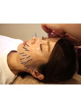 鍼灸施術を受けたい