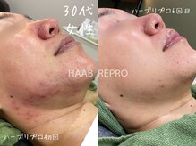 ミコサロン(miko salon)/デトックスハーブピーリング
