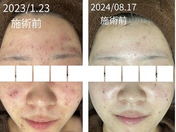 リボーン(REBORN)/ハーブピーリング