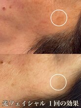 サロン ド マキ(Salon de Maki)/シミケアは最新式光フェイシャル