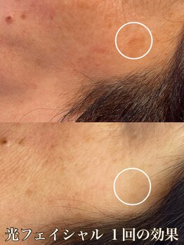 サロン ド マキ(Salon de Maki)/シミケアは最新式光フェイシャル