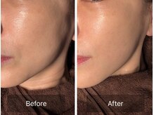 【一番人気！本気の小顔リフトアップコース】サーマでたるみケア