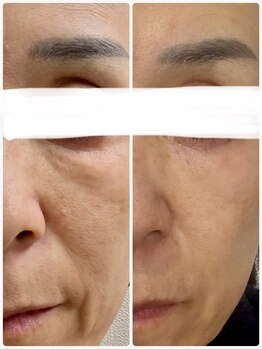 ジュエルビューティー(Jewel Beauty)/Dr.リセラ 本気の肌改善 ADS