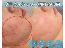 ベルファーム(Belle Femme)/プラズマシャワーで肌荒れ改善へ