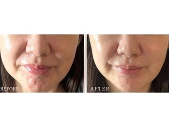 ロジワール(LOISIR)/口元～ほうれい線の印象変化