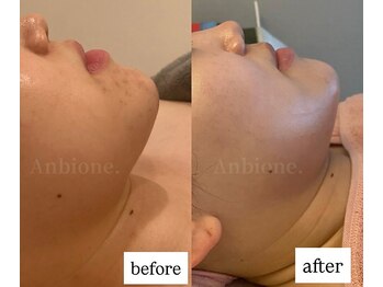 アンビワン(Anbione.)/NMNピーリング