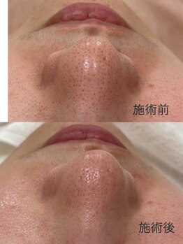 ウェルビーイング(well-being)/いちご鼻でお困りの方必見