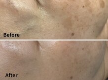 ルーチェ(LUCE)/光フェイシャルBefore→After