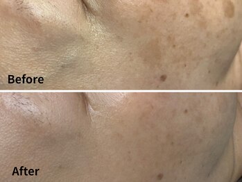 ルーチェ(LUCE)/光フェイシャルBefore→After