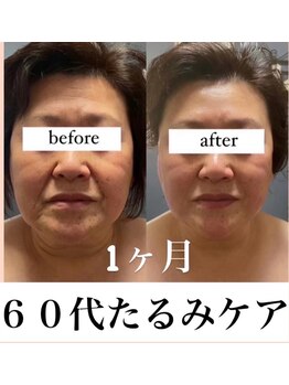 エテルネル(eternel)/エラスチン