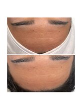 ホワイトワックス 京都四条烏丸(WHITE WAX)/《全顔》フェイシャルワックス