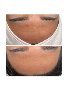 ホワイトワックス 京都四条烏丸(WHITE WAX)/《全顔》フェイシャルワックス