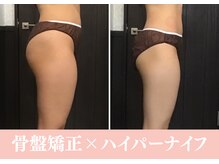 骨盤矯正で根本から痩せやすいお身体作り♪ハイパーナイフ 
