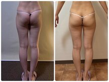 ツボミ(TSUBOMI)/モニター様　before・after