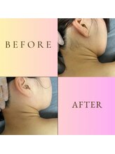 ルナソルビューティーサロン 浜松店(Lunasol)/大人気♪うなじ MIX脱毛