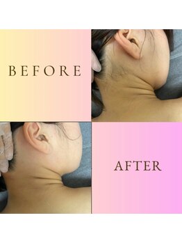 ルナソルビューティーサロン 浜松店(Lunasol)/大人気♪うなじ MIX脱毛