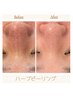 【30代の方へ】毛穴ケアに特化のハーブピーリング／REVI ¥14,300→¥8,800