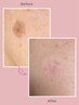 【全顔光フォトに追加】部分的に濃いシミに/スポットシミケア/1か所¥3300
