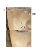 グロウ(glow)/シミ、シワケアと言えばこれ！！