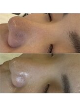 アース 目黒店(Earth)/毛穴洗浄で黒ずみスッキリ