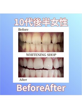 ホワイトニングショップ 西原店/10代後半女性☆BeforeAfter