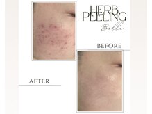 【ニキビ根本改善】繰り返すニキビ悩みを根本から改善！