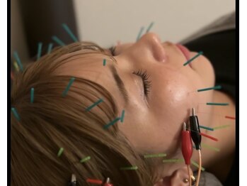 イナリ鍼灸マッサージ院(inare鍼灸マッサージ院)/大人気!美容鍼!