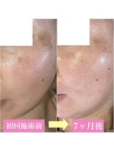 ルアナ(Luana)/【シミ、毛穴改善】