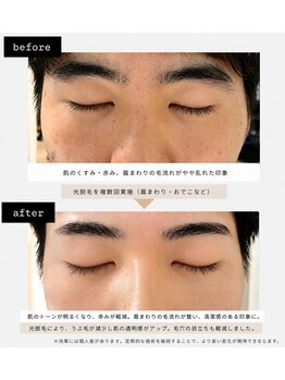 エステサロンセイ(SEI)の写真/メンズ脱毛メニュー★眉スタイリング脱毛が自慢◎メンズ脱毛の細かい部分まで徹底ケアで自信UP！♪